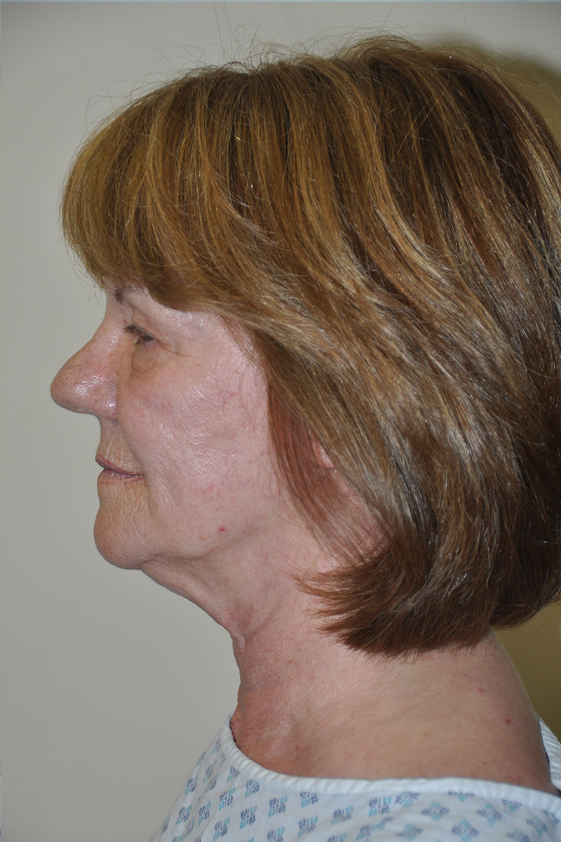 View 3 — before (pre-operative)